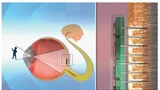 Das Retina-Implantat wird auf die Makula, den Ein- und Austritt der Zentralvene und Zentralarterie, „geklebt“