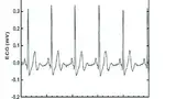 Bild 2: EKG-Signal mit EPIC-Sensor