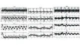 Bild 3: Synchronisierte Aufzeichnung des EKG (obere Kurve) und der Beschleunigung entlang dreier Achsen (x, y, z). Im linken Diagramm geht der Patient (rauschbehaftetes EKG). Im mittleren Diagramm steht der Patient still (Herzrhytmus auch in den xyz-