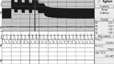 Bild 7: Asymmetrische Wellenform am TSENSE-Pin (Kanal 1) des LTC3880, hervorgerufen durch das injizierte Signal vom Schaltknoten in diesen Pin
