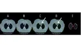 Bild 3: Automatische Erkennung und Markierung der Lunge im CT-Bild (A: Original-CT, B: Erkennung und Markierung des Thorax des Patienten, C: Erkennung und Markierung der Lunge innerhalb der Thoraxmaske, D: Ausschließen der Trachea, E: Ausschneiden de