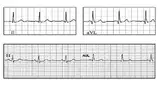Bild 1: Vergleich einer EKG Messung mit Plesseys »EPIC«-Sensoren (unten) und nassen Ag/AgCl-Elektroden (oben)
