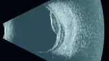 Bild 2: Die B-Scan-Sonde eignet sich für das hintere Segment (wie hier gezeigt) oder einen breiten Bereich des vorderen Segments und liefert ein Bild der Linse in sehr hoher Qualität mit vielen Details, einschließlich der feinen Zonulafasern und Zili