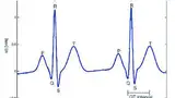 Bild 3: EKG-Signal mit idealer Impulsrate