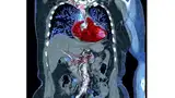 Bild 6: CT-Scan einer Länge von 63 cm mit niedriger Gesamtdosis von 1,9 mSv, durchgeführt mit dem Turbo-Flash-Modus in nur 1,2 s, bei 80 kV und einem Pitch von 2,4. Die Bildqualität ist sehr gut, obwohl der linke Arm des Patienten im Scanbereich verb