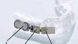 Bild 1a: Zahnschiene zum Monitoring von Bruxismus mit integrierter Batterie (1), Sensorik (2) sowie Sender und Antenne (3)