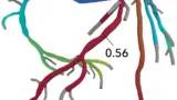 koronare CT-Angiographie plus FFRCT