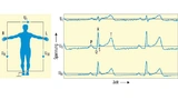 as EKG-Ableitungsschema nach Einthoven (I, II und III) mit typischen Signalen