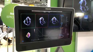 Da ist so eine Ultraschalluntersuchung schon deutlich angenehmer, zum Beispiel bei Philips. In Düsseldorf zeigte das Unternehmen aus den Niederlanden sein neues Premiumsystem mit anatomischer Intelligenz für die Echokardiographie.