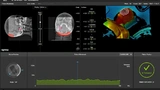 ExacTrac Dynamic Patient Montoring