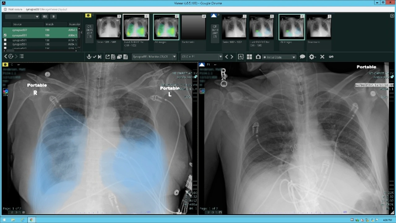 REiLI identifiziert verschiedene Befunde interstitieller Lungenentzündung, die auf CT-Bildern erscheinen, und berechnet deren Verteilung und Volumen. REiLI identifiziert verschiedene Befunde interstitieller Lungenentzündung, die auf CT-Bildern erscheinen, und berechnet deren Verteilung und Volumen.
