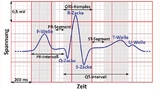 Das EKG-Signal enthält eine Vielzahl an Informationen über die Herzfunktion