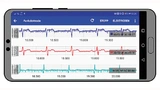 Die Android-App empfängt und verarbeitet die Signale der Funkelektroden und gibt die EKGAufnahme auf dem Display aus, hier dargestellt eine Standardableitung