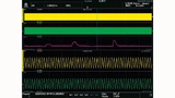Exemplarische Darstellung der Signale mit dem DL950 zur LV 148: 2x Spannung und 1x Tem­peraturverlauf über 30 Minuten bei 1 MS/s. Die Spannungen sind oben mit 3 min/div auf der x-Achse dargestellt und unten im Zoom-Fenster mit 100 μs/div