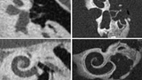 Verbesserte Darstellung des Mittel- und Innenohrs mit quantenzählender CT