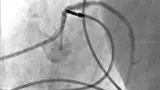 Das Angiografie-System ermöglicht eine gute Darstellung der verwendeten Instrumente wie beispielsweise diagnostischem Katheter oder Ablationskatheter. 