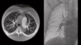 Medizintechnik Krebs Radiologie Siemens Healthineers