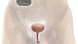 Medizintechnik Implantat Inkontinenz Frau