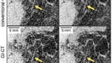 Medizinelektronik computertomographie Brustkrebs früherkennung diagnose mammakarzinom