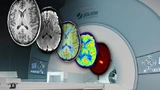 Jülich KI Hirntumor Diagnose Diagnostik PET-Scans MRT