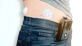  Ein Patient, der ein Gerät zur kontinuierlichen Glukoseüberwachung (CGM) mit einer künstlichen Bauchspeicheldrüse zur Insulinabgabe trägt