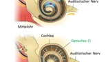 Medizintechnik Hörgeräte Cochlea-Implantate OLED Chip Licht Stimulation Hörnerv