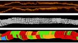 herzinfarkt stent KI tool deepNeo helmholtz TUM Algorithmus Künstliche INtelligenz Nachsorge Klinik
