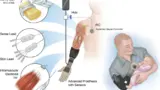 Übersicht über das iSens-Systems und seine implantierten Komponenten.