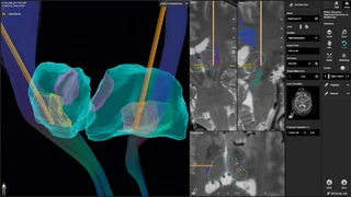 Bild 1. Brainlab Elements  Segmentation erzeugt mit einer voxelweisen Analyse der Bildgebungsdaten genaue, patientenspezifische anatomische Strukturen.